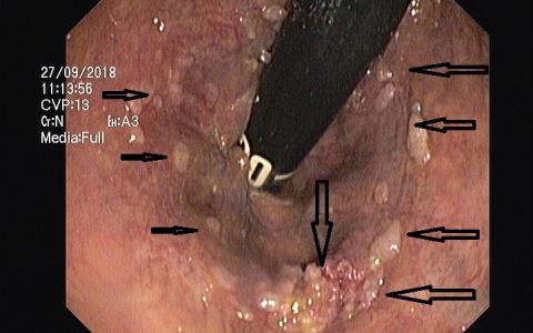 APC – Διαθερμοπηξία με argon plasma coagulation!