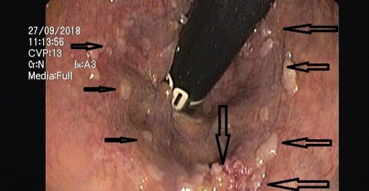 APC – Διαθερμοπηξία με argon plasma coagulation!